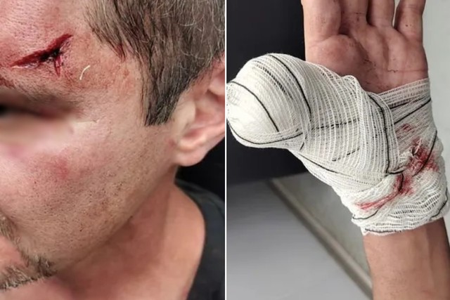 Homem leva mordida no braço e perde parte do dedo após briga por comanda em bar no litoral de SP