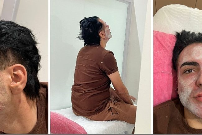 Deputado Propõe Regulamentação do Peeling de Fenol na Alesp Após Morte de Empresário