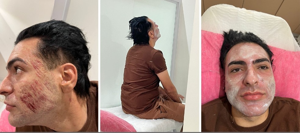 Deputado Propõe Regulamentação do Peeling de Fenol na Alesp Após Morte de Empresário
