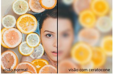 Pesquisa revela que 45,8% da população não tem conhecimento sobre ceratocone