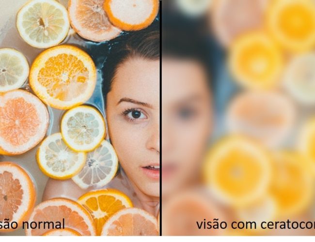 Pesquisa revela que 45,8% da população não tem conhecimento sobre ceratocone