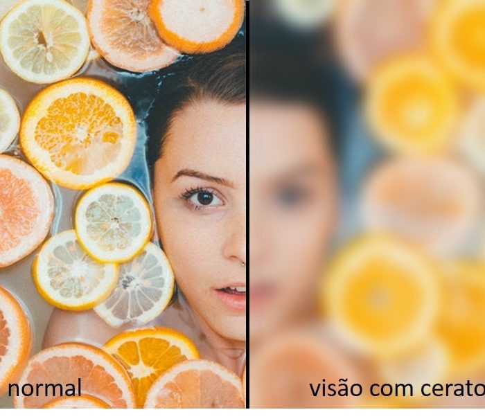 Pesquisa revela que 45,8% da população não tem conhecimento sobre ceratocone